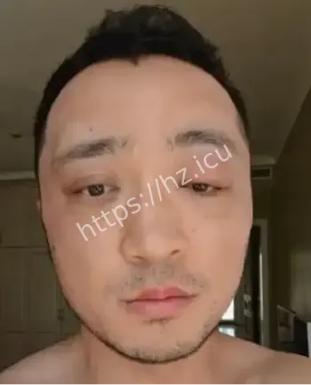 尼格买提染发过敏